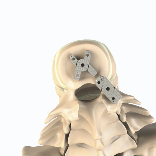 LWS-Zwischenwirbelimplantat - XLIF - Aditus Medical - dorsaler Zugang / lateraler Zugang / aus PEEK