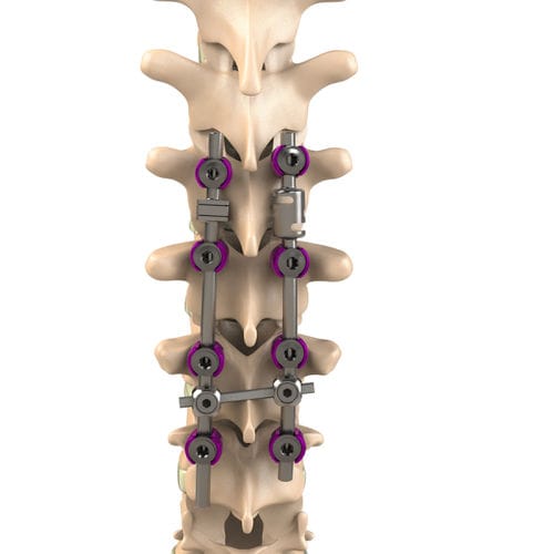 Thorako-lumbales Stabilisierungssystem für Osteosynthese - Aditus Medical - dorsaler Zugang / für Erwachsene