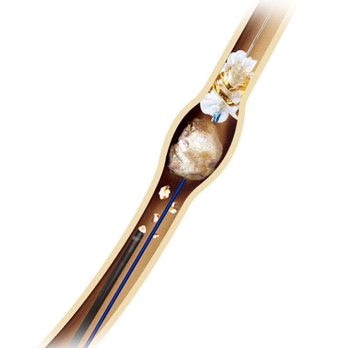 Katheter zur Steinextraktion - Innovex Medical - Ureter / mit hydrophiler Beschichtung