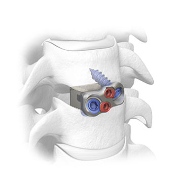 HWS-Zwischenwirbelimplantat - Ceres®-C - SPINAL elements - ventraler Zugang / aus PEEK / mit Zervikalknochenplatte