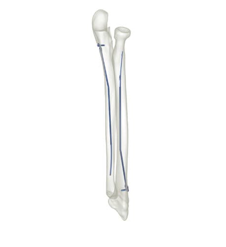 Marknagel für Radius - 83527 series - Peditst - für Ulna / Titan