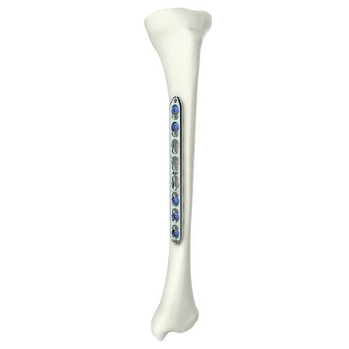 Kompressionsplatte für Humerus - 317270000 series - Peditst - für Tibia / mit Verriegelung / Titan