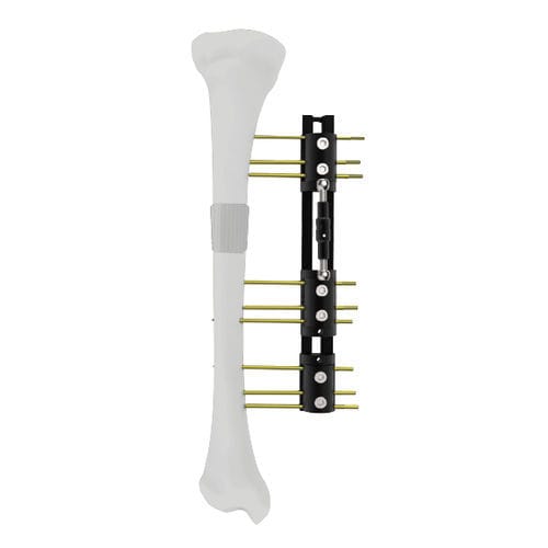 Fixateur externe / für Tibia - LRS - Peditst - für Oberschenkelknochen / rohrförmig / für Kinder