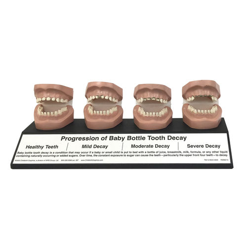 Anatomisches Modell / Karies - 79212 - Health Edco & Childbirth Graphics - Mund / für Zahnbehandlung / Kinder