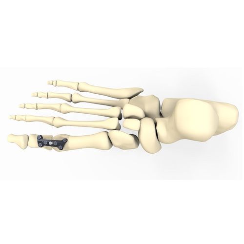 Arthrodeseplatte für Hallux Valgus - FRC20 series - Aleda Medical - mit Verriegelung / Metall
