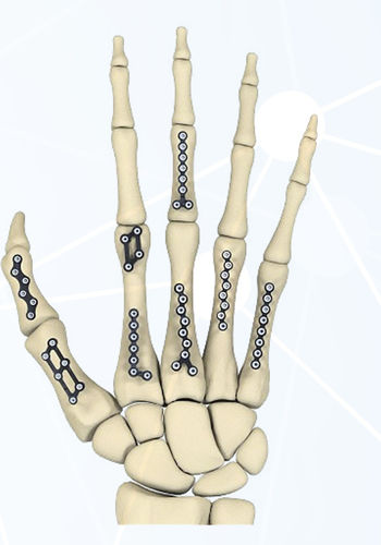 Kompressionsplatte für Fingerglied - FRC series - Aleda Medical - für Mittelhandknochen / mit Verriegelung / Metall
