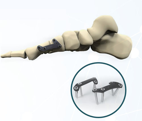 Arthrodeseplatte für Hallux Valgus - FRC200 series - Aleda Medical - mit Verriegelung / Metall