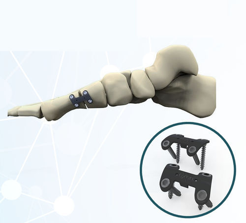 Arthrodeseplatte für Hallux Valgus - FRC20 series - Aleda Medical - mit Verriegelung / Metall