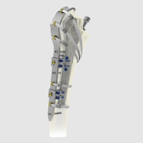 Kompressionsplatte für periprothetische Femur-Fraktur - Ortholox®  - Ortolog Medikal - proximal / mit Verriegelung / Titan
