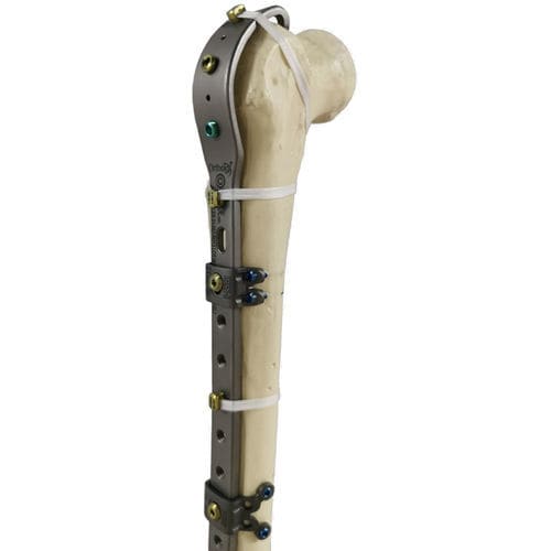 Kompressionsplatte für periprothetische Femur-Fraktur - Ortholox®  - Ortolog Medikal - proximal / distal / mit Verriegelung