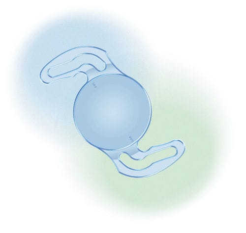 Torische Intraokularlinse - EVToric - Aurolab - für Astigmatismus
