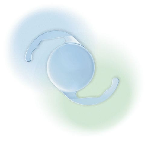 Monofokale Intraokularlinse - Evpl - Aurolab