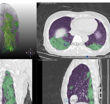 Bildanalyse-Software - MEDIP Pneumovid - MEDICALIP Co., Ltd. - Visualisierung / überwacht / Computertomographie