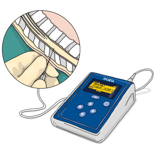 Biochemisches Analysegerät / cerebro-spinale Flüssigkeit - Injeq IQ-Tip® - Injeq Ltd. - automatisch / Tisch