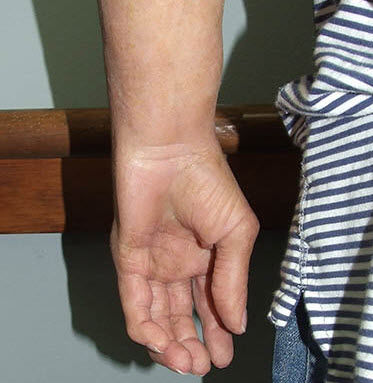 Kosmetische Handprothese - Medical Art Prosthetics - für Erwachsene