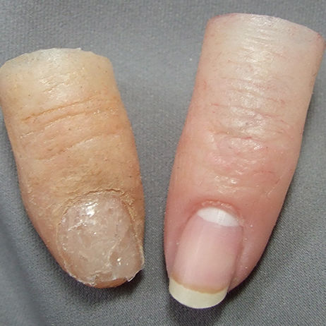 Kosmetische Fingerprothese - Medical Art Prosthetics - für Erwachsene