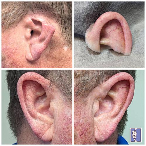 Kosmetische Ohrenprothese - Medical Art Prosthetics - Teil / für Erwachsene