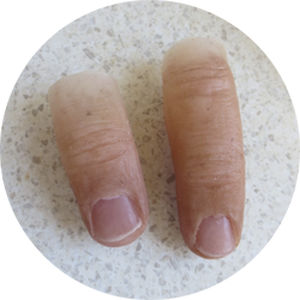 Kosmetische Fingerprothese - Northern Prosthetics