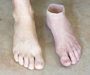 Kosmetische Fußprothese - Northern Prosthetics - für Erwachsene