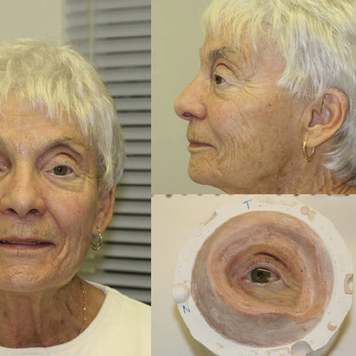 Kosmetische Orbitalprothese - Prosthetic Artists - für Erwachsene