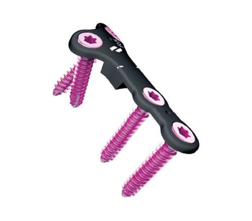 Osteotomieplatte für Hallux Valgus - Airlock® - novastep - mit Verriegelung / Metall