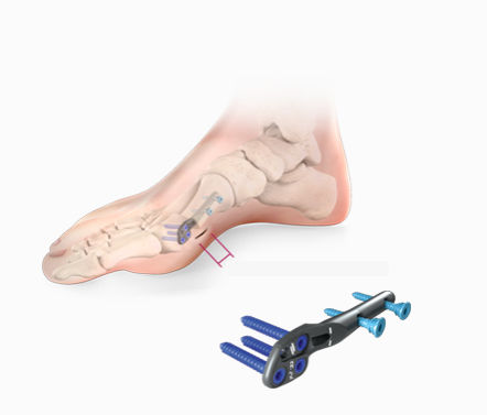Osteotomieplatte für Hallux Valgus - Centrolock® - novastep - seitlich / mit Verriegelung / Metall