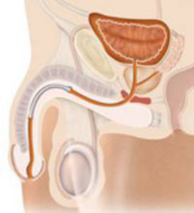 Harnröhrenstent - Memokath™ 044, Memokath™ 045 - PNN Medical - Nitinol
