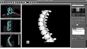 Medizinische Software - ZedView - LEXI Co. - Computertomographie / für Wirbelsäulenchirurgie / Viewer