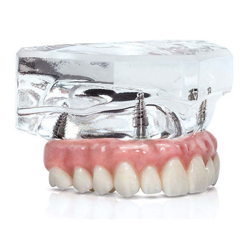 Anatomisches Modell / Mund - BruxZir&reg; - Glidewell Direct - Zahn / Gebiss / Kiefer