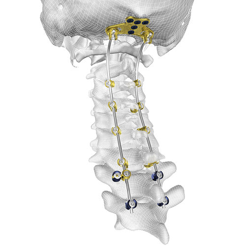 Okzipito-zervikothorakales Stabilisierungssystem für Osteosynthese - TIGER® - Corelink Surgical - dorsaler Zugang / für Erwachsene
