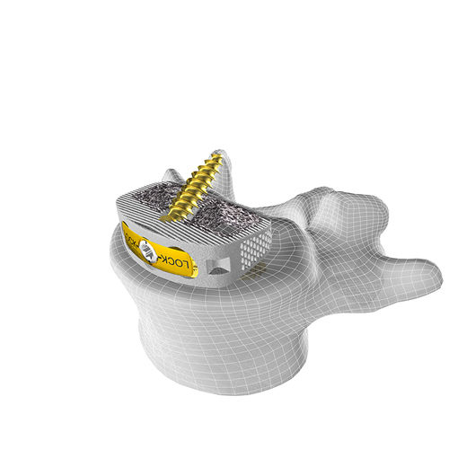 LWS-Zwischenwirbelimplantat - M3 STAND-ALONE ALIF - Corelink Surgical - ventraler Zugang