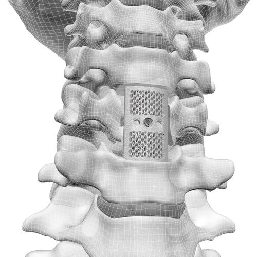 Korpektomie-Wirbelkörperprothese / HWS - F3D - Corelink Surgical - 3D-Druck