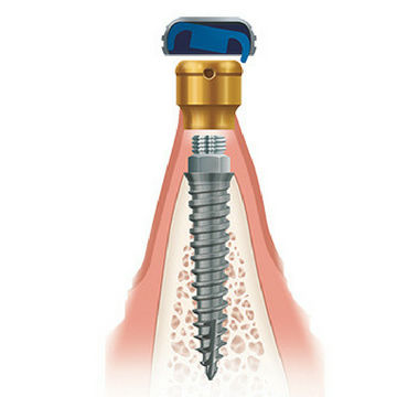 Titan-Zahnimplantat - Zest Dental Solutions - anatomisch / schmal / zur kieferorthopädischen Verankerung