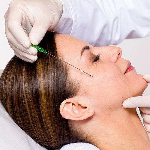 Resorbierbarer Liftingfaden - PDO - Croma Pharma