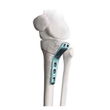 Osteotomieplatte für Tibia - WEGO Medical - proximal / seitlich