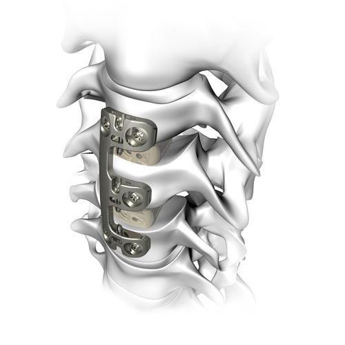 HWS-Arthrodeseplatte - VERTEVIEW - Atlas Spine - mit Verriegelung / Metall / 2 Ebenen
