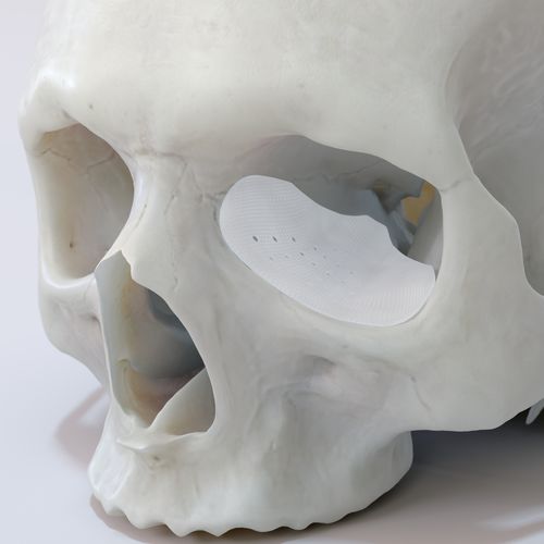 Patientenspezifisches Orbitalimplantat - TnR series - T&R Biofab - resorbierbar