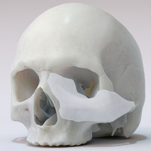 Patientenspezifisches Orbitalimplantat - TnR PSI - T&R Biofab - resorbierbar