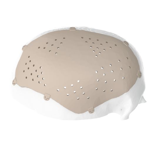 Patientenspezifisches Schädelimplantat - Kune Implants