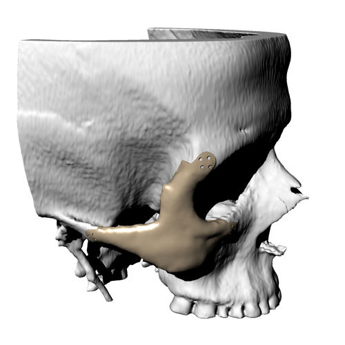 Patientenspezifisches Orbitalimplantat - Kune Implants - nicht resorbierbar