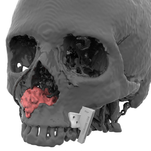 Schneidschablone für Kiefer- und gesichtschirurgischen Aufbau - Kune Implants