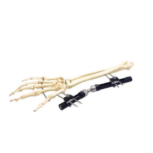 Fixateur externe / für Handgelenk - Wuhan Yijiabao Biological Materials - rohrförmig / für Erwachsene