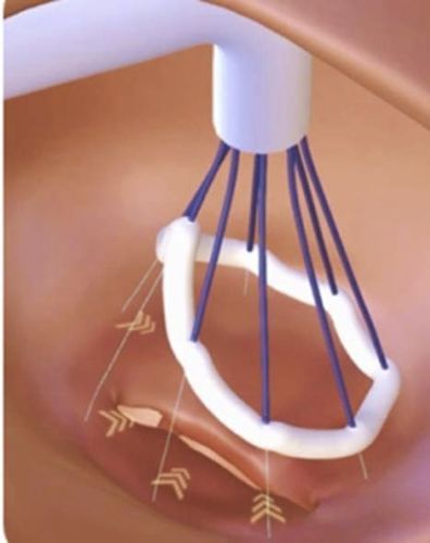 Herz-Reparatursystem / Mitralklappe - Valfix Medical - Trikuspidalklappe