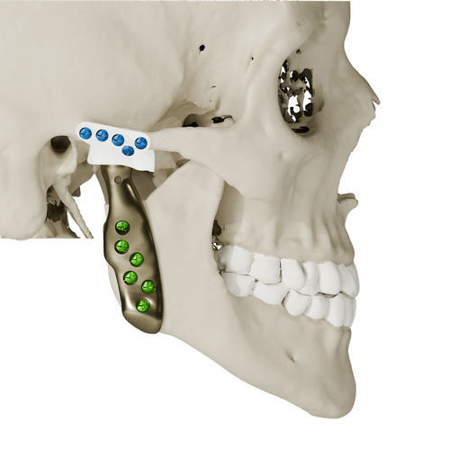 patientenspezifisches Kiefergelenkimplantat - Craniotech