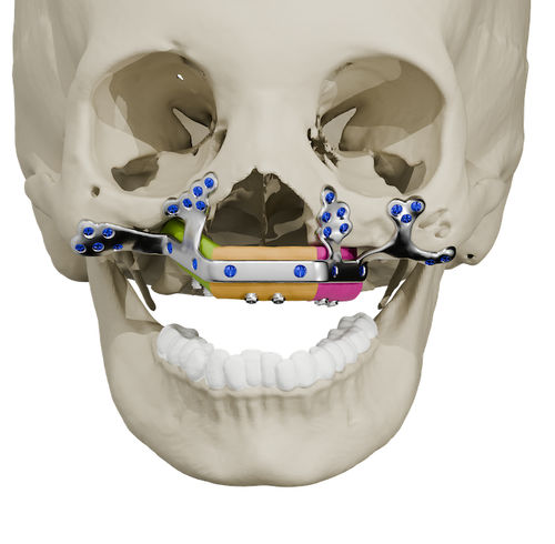 Patientenspezifischer Oberkieferimplantat - Craniotech