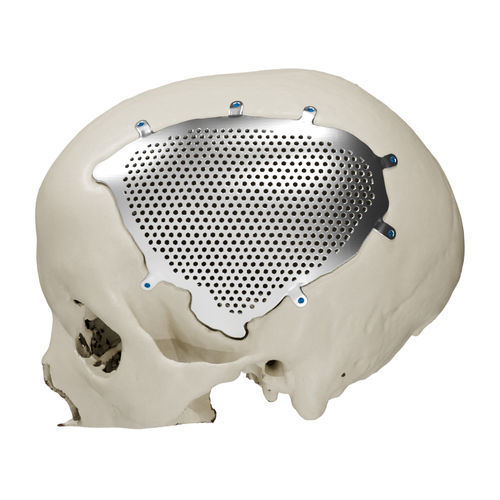 Patientenspezifisches Schädelimplantat - Craniotech