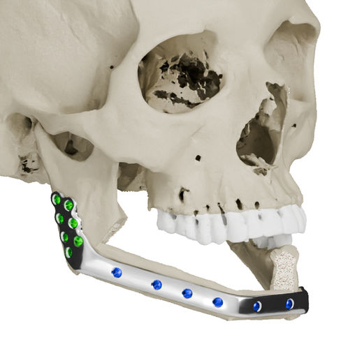 Patientenspezifisches Unterkieferimplantat - Craniotech - nicht resorbierbar