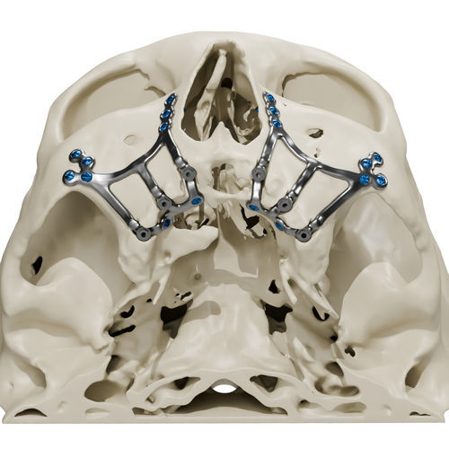 Maßgefertigter subperiostales Implantat - Craniotech - Titan / anatomisch / subperiostal