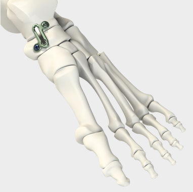 Arthrodeseplatte für Talonavikulargelenk - DynaFORCE® T/N FUSION - CrossRoads Extremity Systems - Metall