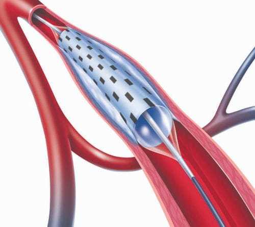PTA-Katheter - PolarCath  - Nucryo Vascular - Kniekehlen-Arterie / Femuraarterie / Arteria iliaca